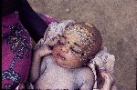 21. Baby wearing kola paint on fontanel